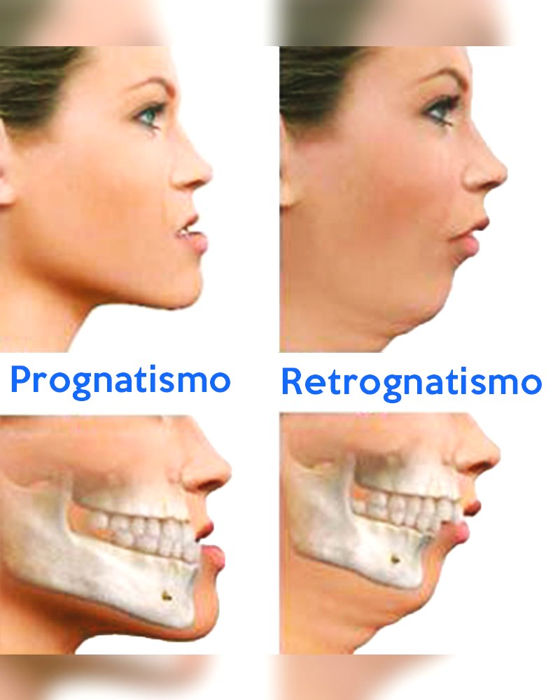 Clase II o Retrognatia Mandibular» Cirugía Ortognática - Instituto