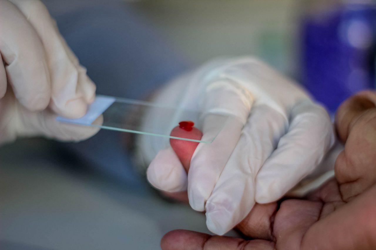 Rondônia avança no controle da malária com tratamento eficaz em dose única, fortalecendo controle da transmissão no estado