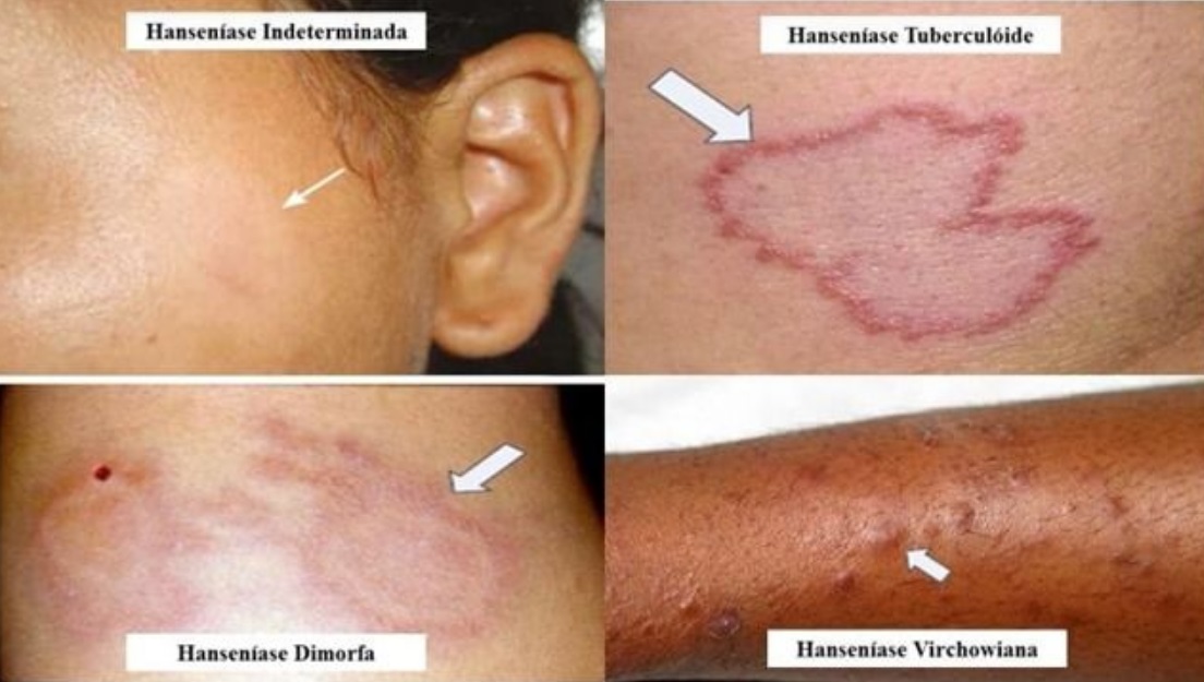 Hanseníase: o que é, quais os sintomas e tratamentos - Exmed blog